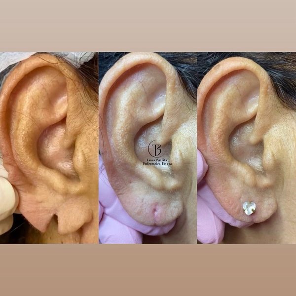 Resultado antes e depois - Lobuloplastia