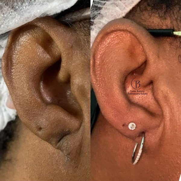 Resultado antes e depois - Lobuloplastia