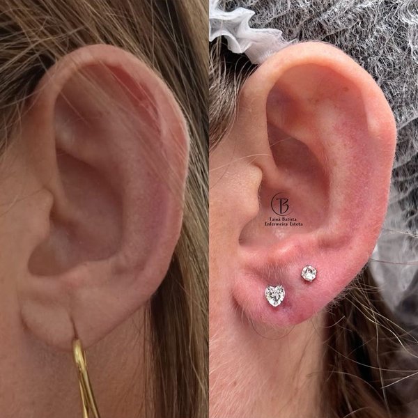 Resultado antes e depois - Lobuloplastia