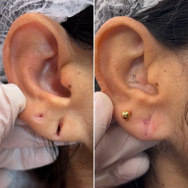 Resultado antes e depois - Lobuloplastia