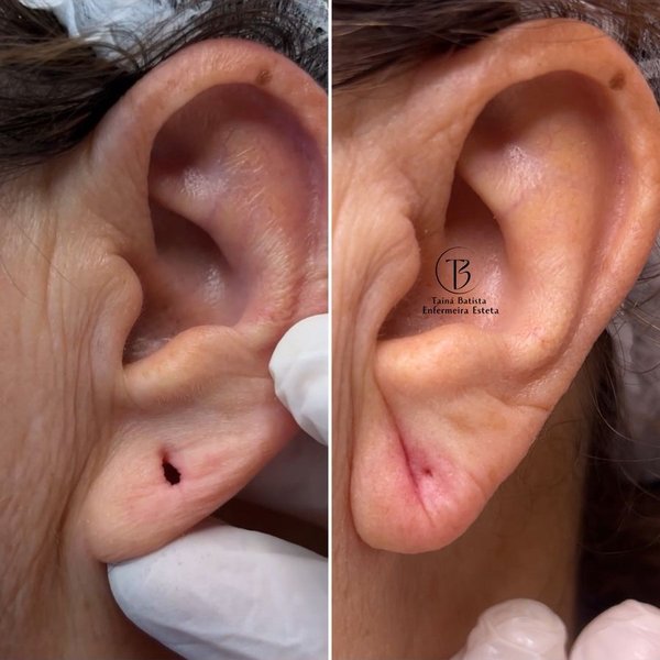 Resultado antes e depois - Lobuloplastia